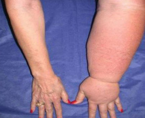 Como tratar e identificar un Linfedema