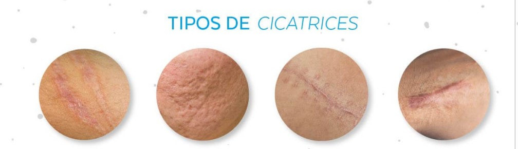 ¿Qué es una cicatriz? Te lo explicamos
