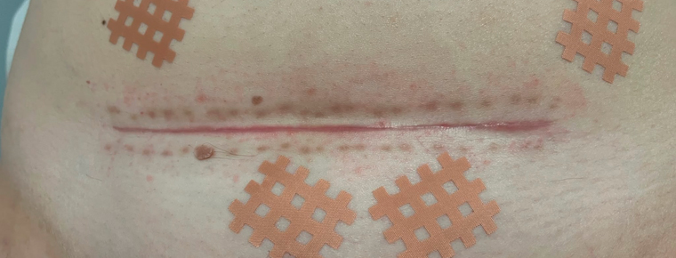 Tratamiento de cicatrices con fisioterapia dermatofuncional en Albacete