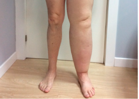 Síntomas de linfedema en piernas